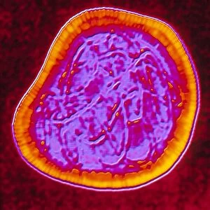 Coloured TEM of a rubella (German measles) virus